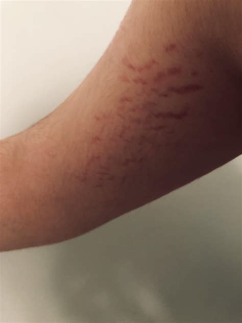 What are these weird red spots on my upper arm, they are also on my other arm. These have been ...