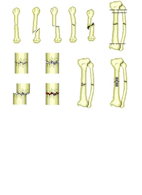 The Different Types of Bone Fractures: Anatomy Model
