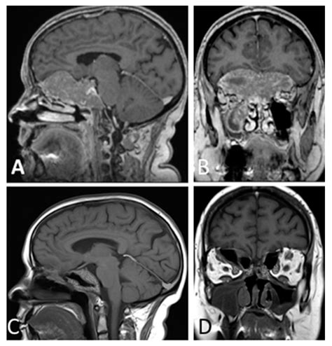 Primary Endoscopic Endonasal Management of Giant Pituitary Adenomas ...