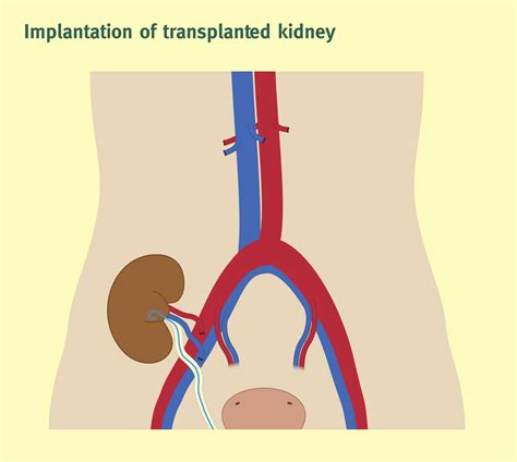 Kidney Transplant Zones at Maya Hart blog