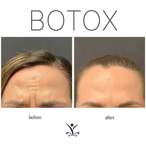 The benefits of botox – Artofit