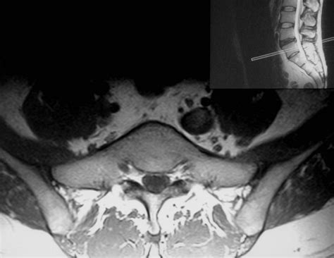 Numbering of Lumbosacral Transitional Vertebrae on MRI: Role of the ...