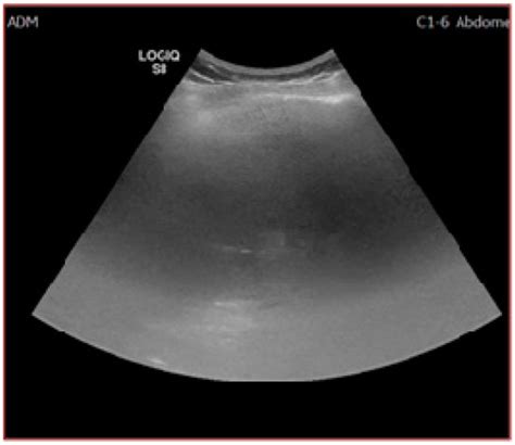 Ultrasound or Sectional Imaging Techniques as Screening Tools for ...