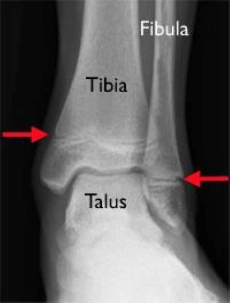 Ankle Fractures In Children - OrthoInfo - AAOS