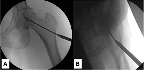 Arthroscopy-Assisted Core Decompression and Bone Grafting for Avascular Necrosis of the Hip ...