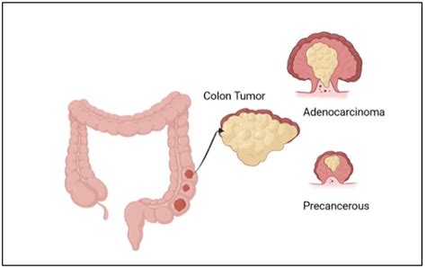 How Fast Does Colon Cancer Grow