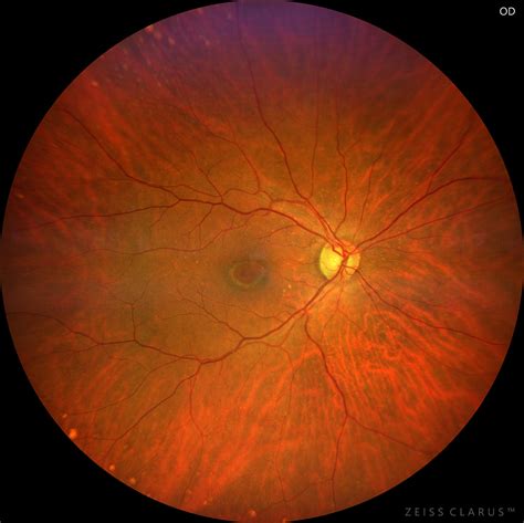 Bull’s eye maculopathy related to antimalarial drugs – Retinography