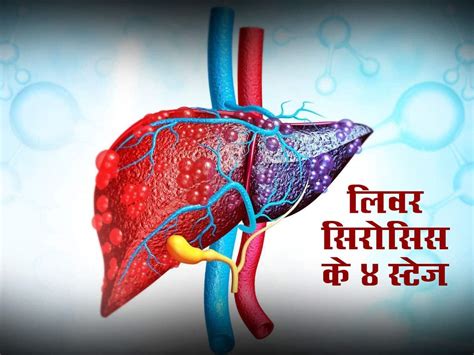 लिवर में सूजन से लेकर लिवर फेलियर तक लिवर सिरोसिस के 4 स्टेज | Stages ...