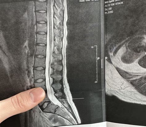 Tethered Spinal Cord Syndrome Dynamic Magnetic Resonance Imaging