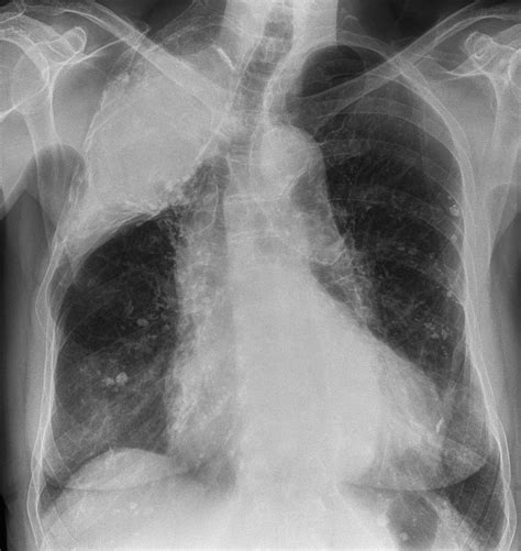 Mild cough and decreased breath sounds in an 82 year old woman | The BMJ