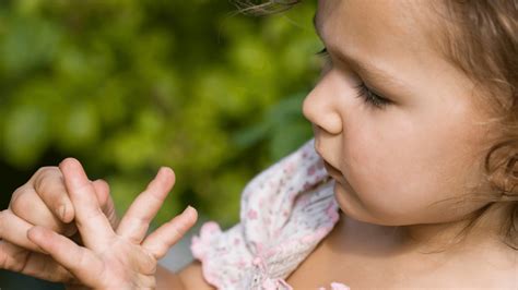 Splinter Finger 的图像结果