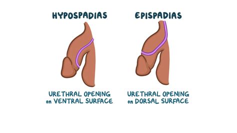 Epispadias Vs Hypospadias Epispadias Is Different From Hypospadias