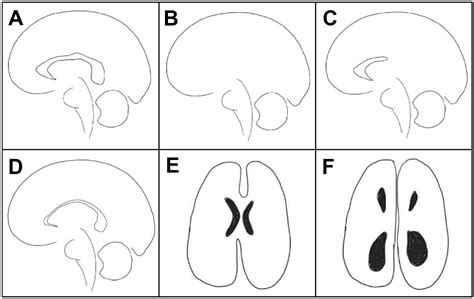 Scoping Review of the Prenatal Diagnosis of Agenesis of the Corpus Callosum - Journal of ...