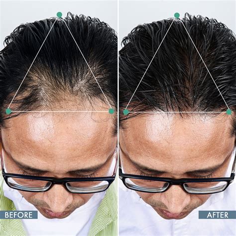 Best DHT Blocker for Men | ThriveCo DHT Blocker Supplement