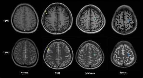 Alcohol Consumption Leads to Brain Shrinkage - How Alcoholism Ruins Up ...