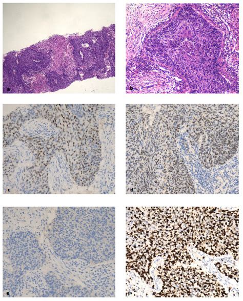 Breast Cancer Molecular Subtyping in Practice: A Real-World Study of ...