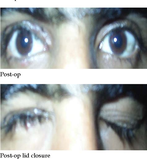 Image result for Levator Resection Surgery