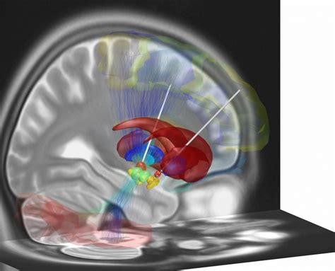 Image result for DBS Tutorial