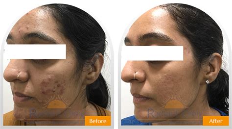 Before-After | Skin and Hair Treatment Results - Radiant Clinic