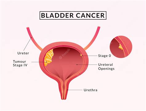 Bladder Cancer 的图像结果