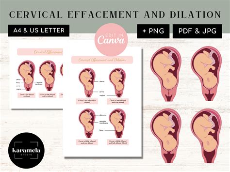Cervical Effacement and Dilation | PNG Images & Canva | PDF + JPG | Female Reproductive System ...