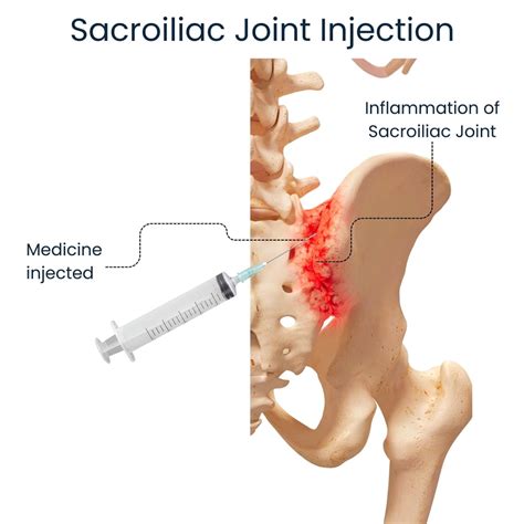 Image result for SI Joint Injection Procedure