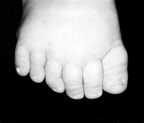 Image of Bardet - Biedl Syndrome