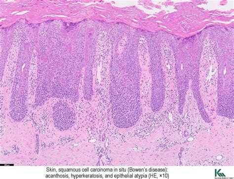 squamous cell carcinoma in situとは: 有棘細胞癌 写真 – YCQRE