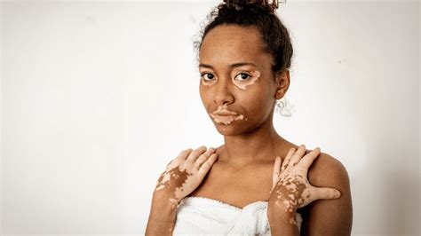 Vitiligo on Lips: How to Treat White Patches on Lips | Clinikally