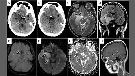 Understanding herpes simplex encephalitis causes and risk