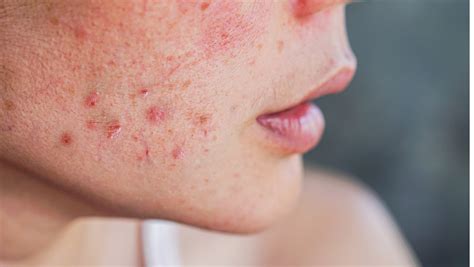 Skin Rashes – Medi Factory