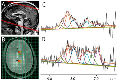Downfield Proton MRSI at 3 Tesla: A Pilot Study in Human Brain Tumors