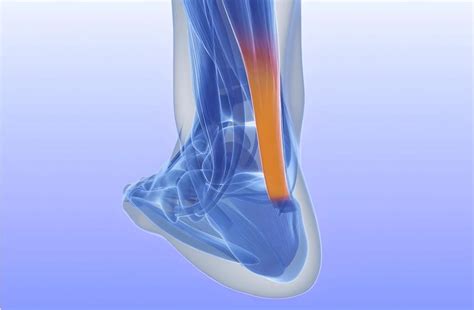 Achilles Tendon Lengthening Surgery for Diabetic Foot