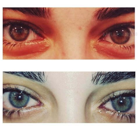 Image result for Eye Color Change Procedure
