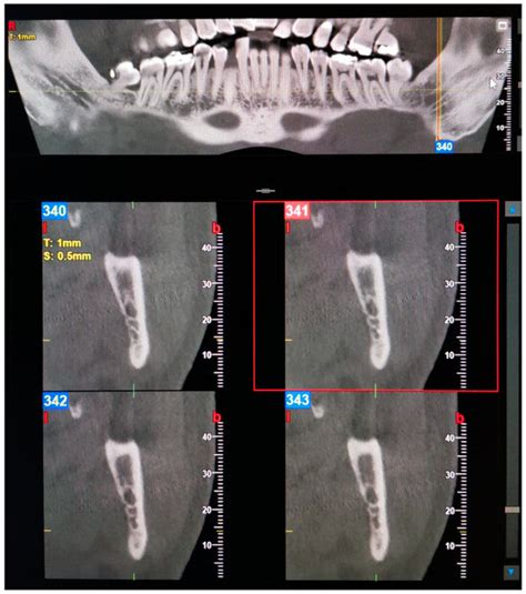 Cone-Beam Computed Tomography Assessment of Bifid and Trifid Mandibular ...