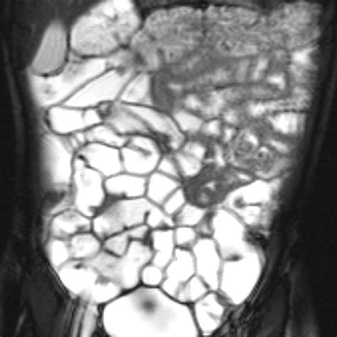 MR Small-Bowel Follow-Through for Investigation of Suspected Pediatric ...