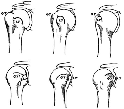 Hill-Sachs defect • LITFL • Medical Eponym Library