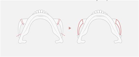 Image result for Cheekbones Reduction Book