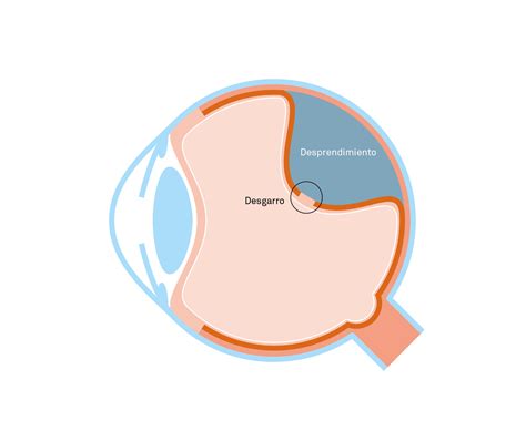Key points to distinguish between retinal detachment and vitreous detachment