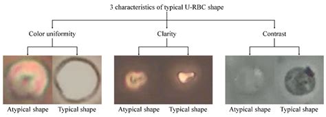 High Red Blood Cells Urine