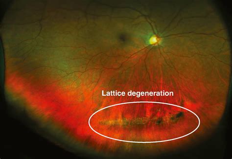 Lattice Degeneration - Clinical Tree