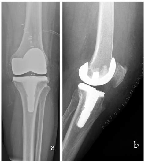 Medial Congruent and Medial Pivot Inserts in Total Knee Arthroplasty: A Scoping Review
