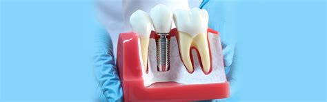 Wisdom Tooth Extraction Treatment in Pragathi Nagar