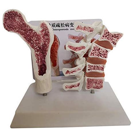 Educational Model Anatomical Model Of Osteoporosis Of The Human Femur ...
