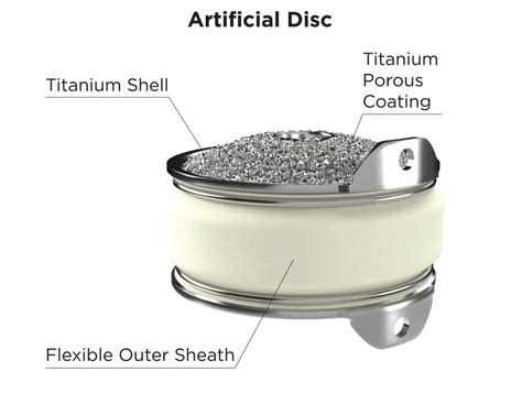 Image result for Disc Replacement Procedure