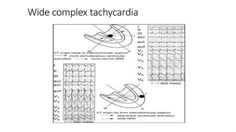 wide complex tachycardia.pptx