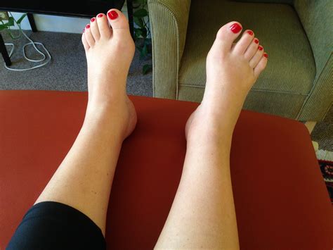 Foot and Ankle Swelling Change after 30 Minutes of Treating the ...