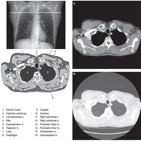Types Of Chest Ct Scan at Donald Blanton blog