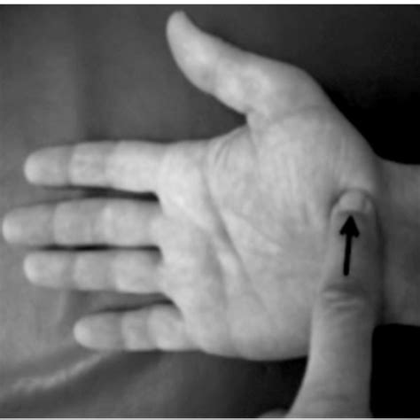 Scaphoid Fracture Test 的图像结果