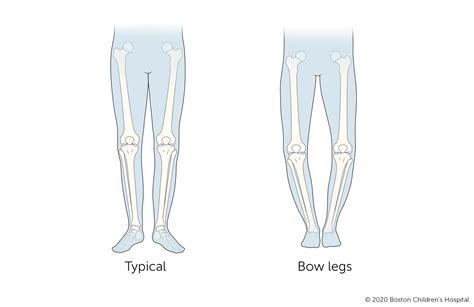 Bowlegs | Boston Children's Hospital